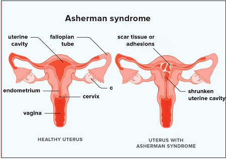 Asherman's Syndrome