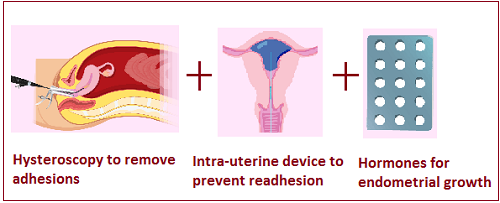 Treatment of Asherman's Syndrome